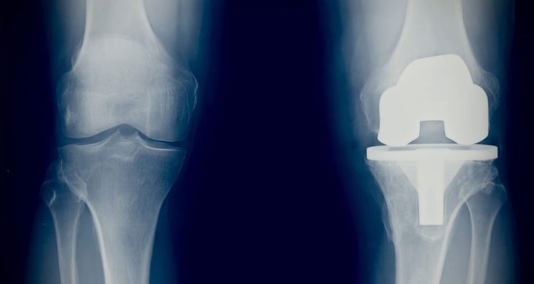 , The Challenges Associated with Revision Arthroplasty