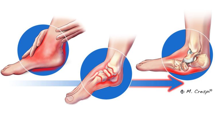 , Charcot Arthropathy Symptoms and Initial Stage