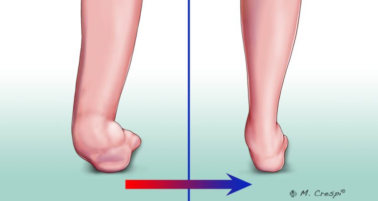 , Charcot Surgical Reconstruction