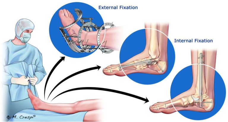 Charcot Foot and Ankle Definition and Classification - Orthofix