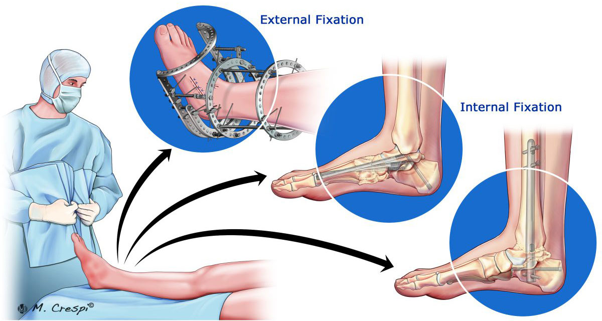 , Surgical Approaches for Charcot Foot