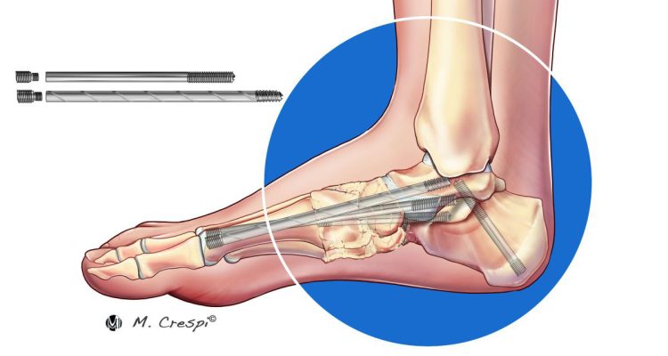 , Charcot Foot Reconstruction Using Internal Fixation