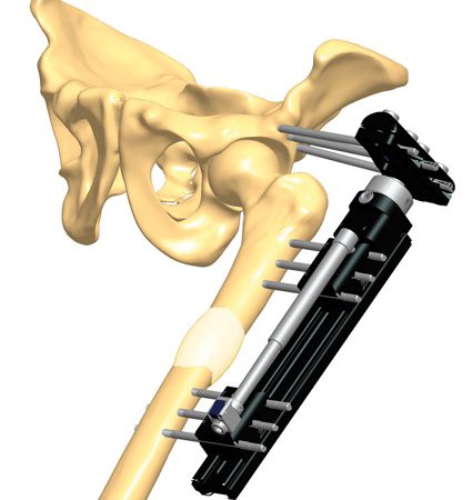 2B7 Fusion with concomitant femoral lengthening