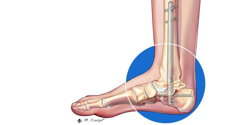 , Surgical Management of the Charcot Ankle