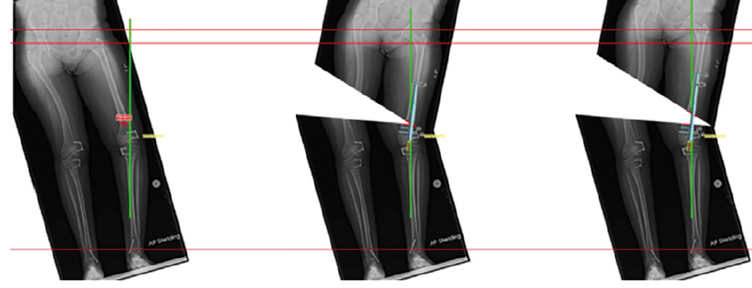 , Enabling Technologies in Limb Reconstruction: The OrthoNext Digital Planning Platform